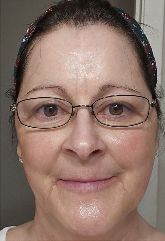 After 3 treatments
