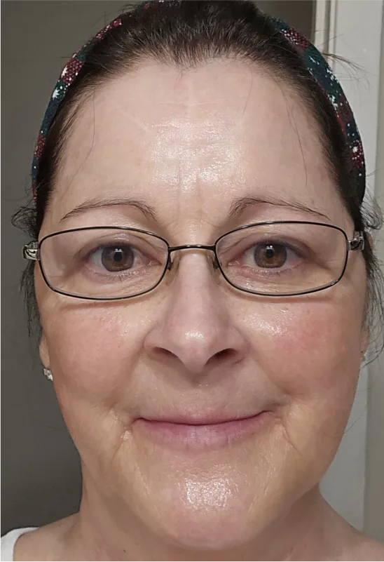 After 3 treatments