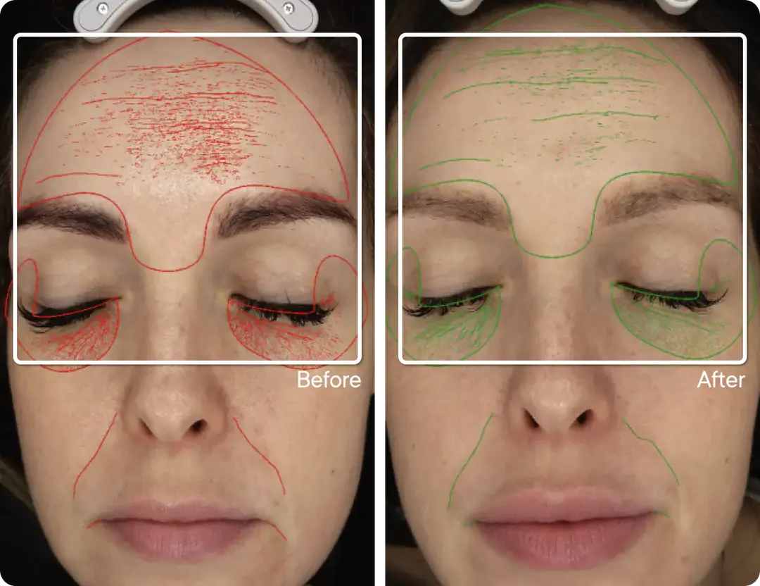Study participant before and after Micro-Infusion, fine lines and wrinkles mapped