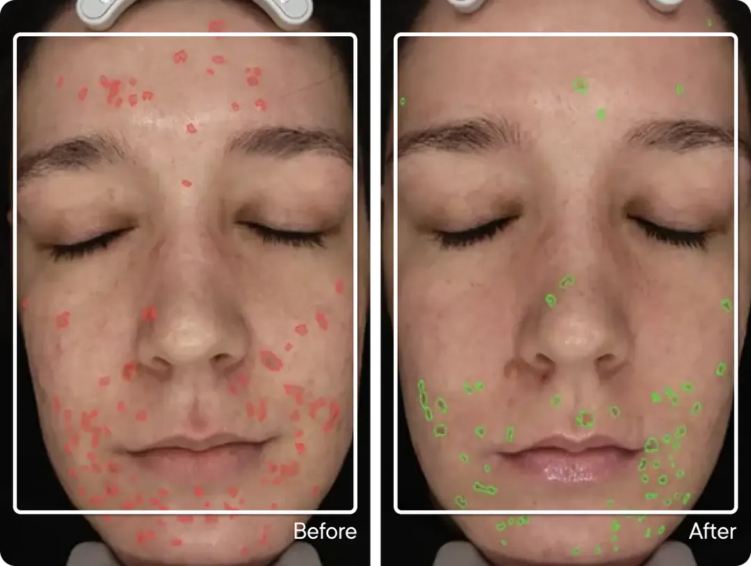 Study participant before and after Micro-Infusion, dark spots mapped