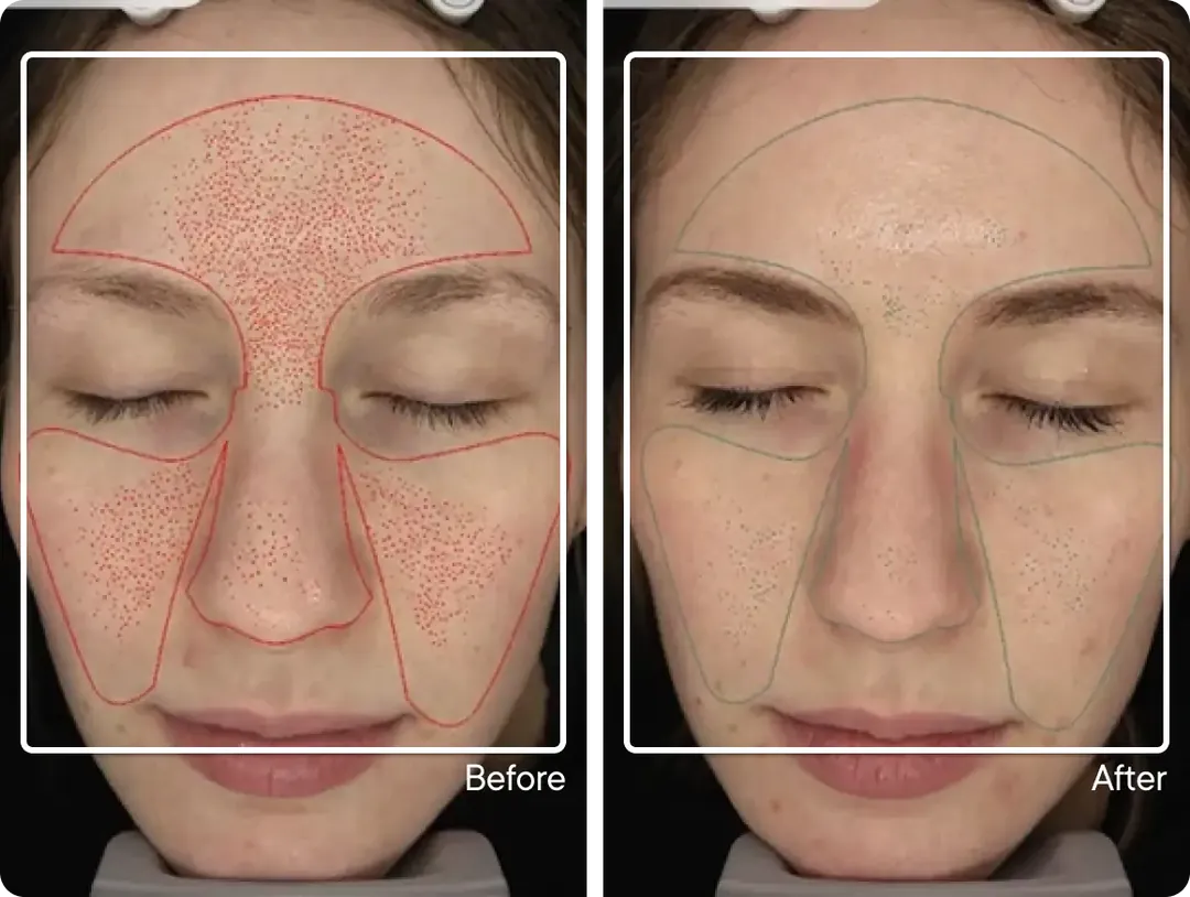 Study participant before and after Micro-Infusion, fine lines mapped