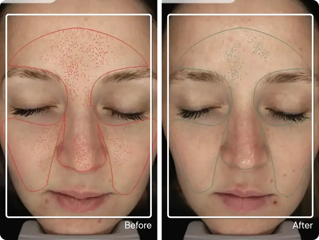 Study participant before and after Micro-Infusion, dark spots mapped