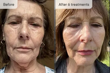 Shelly S. before and after Micro-Infusion &mdash; wrinkles