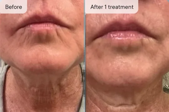 Jennifer N. before and after Micro-Infusion &mdash; smokers lines