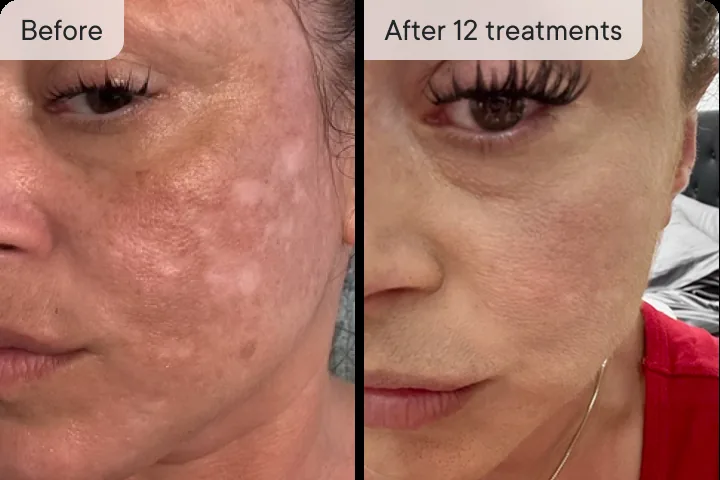 Janeda T. before and after Micro-Infusion &mdash; dark spots