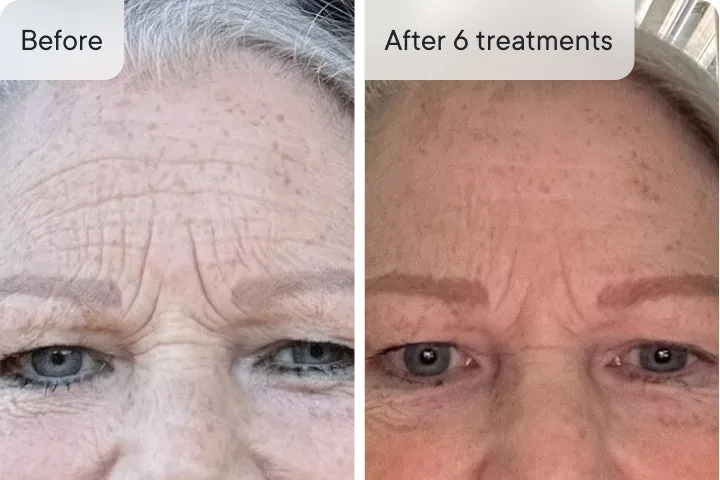 Marilyn B. before and after Micro-Infusion &mdash; forehead wrinkles