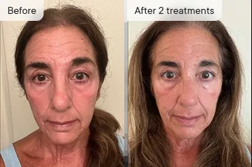 Andrea G. before and after Micro-Infusion &mdash; sagging skin