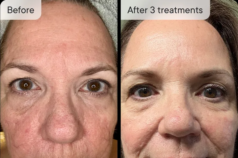 Lourdes F. before and after Micro-Infusion &mdash; wrinkles
