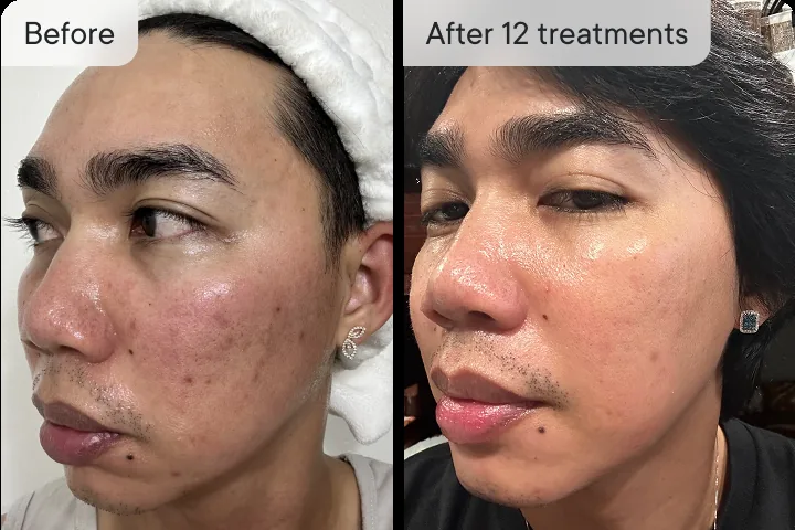 Rodrigo M. before and after Micro-Infusion &mdash; acne scars