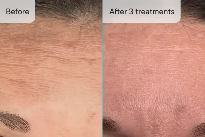 Andrea F. before and after Micro-Infusion &mdash; dark spots