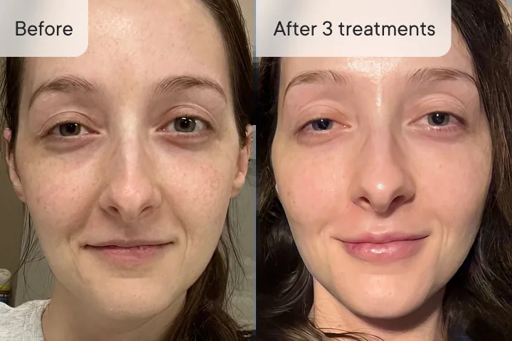 Hannah J. before and after Micro-Infusion &mdash; glow