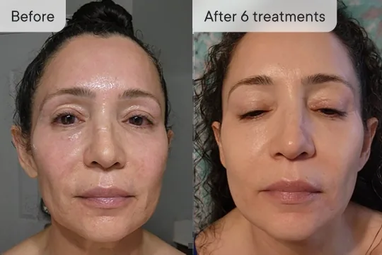 Ellie V. before and after Micro-Infusion &mdash; glow