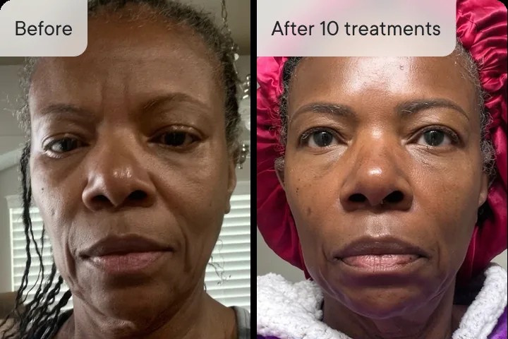 Pamela S. before and after Micro-Infusion &mdash; fine lines