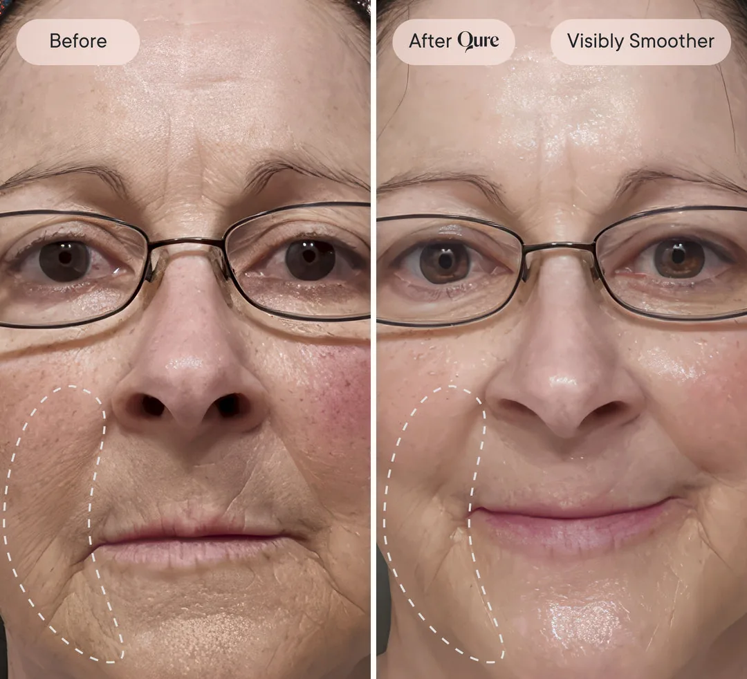 Before and after: visibly smoother skin