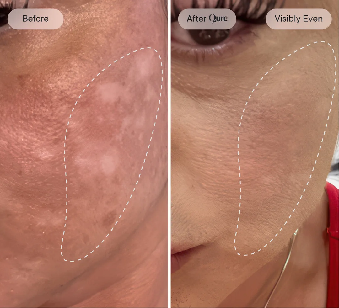 Before and after: visibly even tone