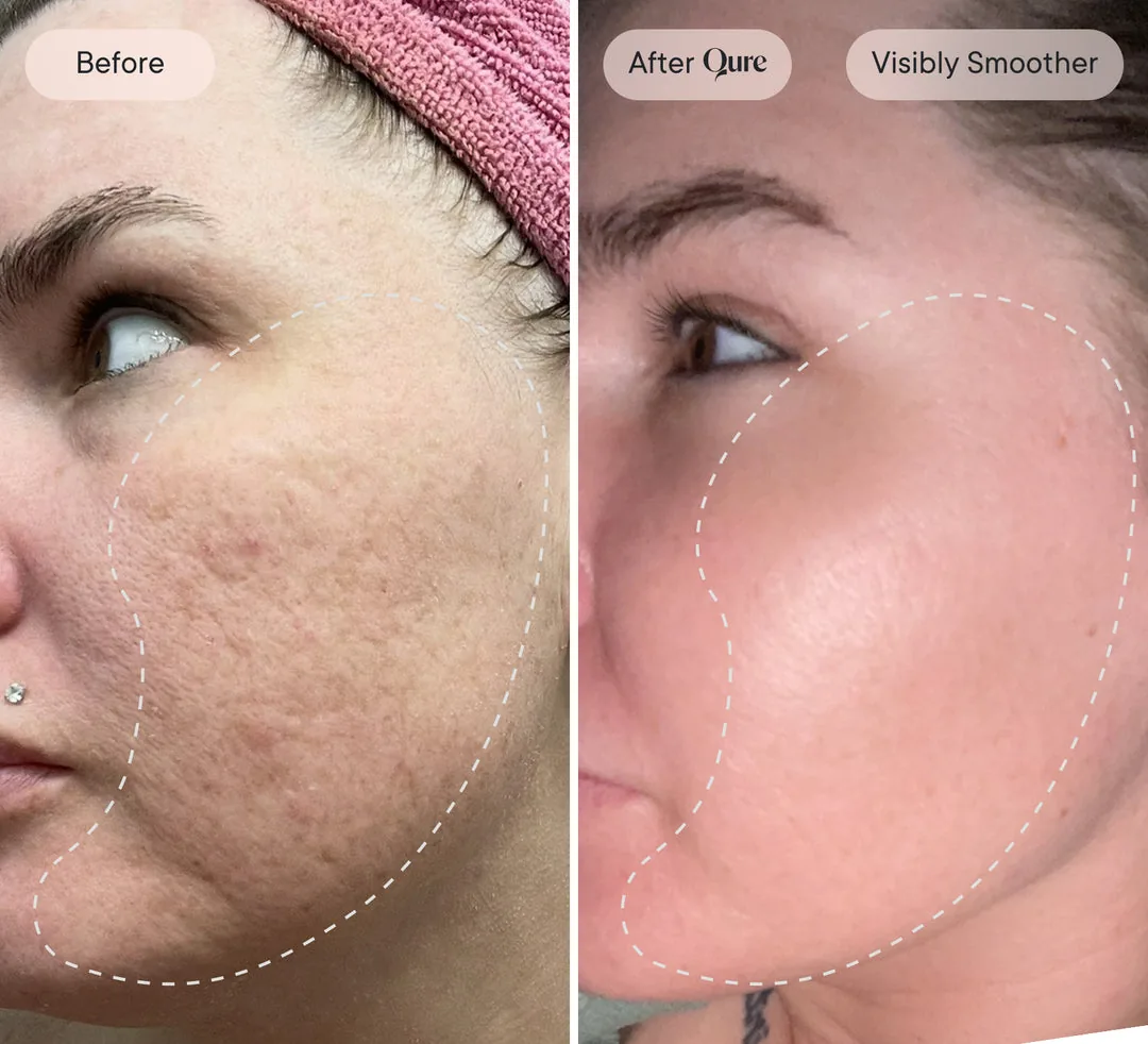 Before and after: visibly smoother skin